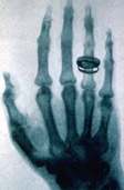 Bertha Roentgen's Hand Bertha Roentgen's Hand